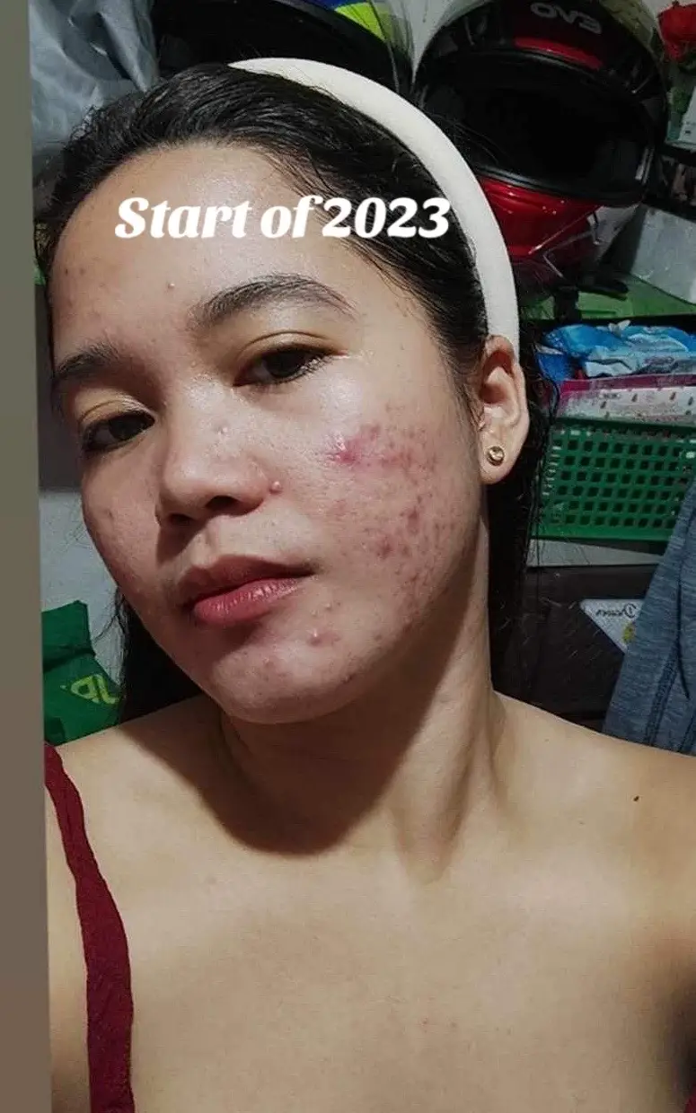 Acne journey 😉#fypシ゚viral #acnefighter #acneskin #