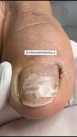 #satisfying #videosatisfatorio #unhaencravada #onicofose 