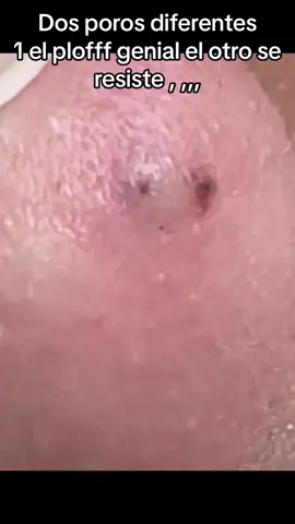 #Extracción #poros #granos#pelo #espinillas #limpiezafacial #acne #tratamientos 