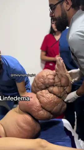 @Luis Lopez Montoya  @Luis Lopez Montoya Evolución de 6 semanas de tratamiento no quirurgico del linfedema: terapia compresiva por vendajes especiales, cuidado de úlceras y piel, ejercicios especiales, control de otras enfermedades. (NO DRENAJE LINFATICO, NO DIURETICOS, NO PRESOTERAPIA, NO APARATOS VARIOS), spoiler: los líquidos se van en primer lugar por diuresis (hacer del 1) y todos los mecanísmos de perdida hídrica del cuerpo y la piel se descama lo sobrante, otra parte se retrae, otra parte se reabsorbe y otra parte queda flacida permanentemente. No hay necesidad de cirugía porque en realidad es muy poca y el tratamiento continuará siendo el mismo para mantener al paciente en buenas condiciones. #linfedema #linfedemaprimario #medicina #fisioterapia #enfermeria #ciencia #Science #medicine #rehab #health #lymphedema  #primarylymphedema 