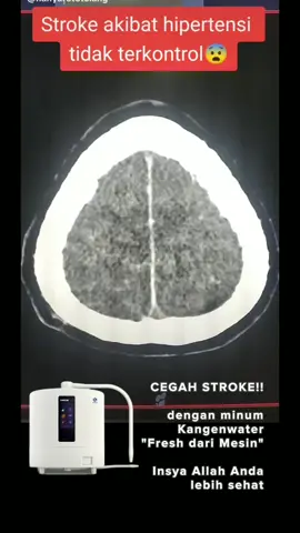 Assalamualakikum selamat Pagi  Ijin Berbagi  Sehat tanpa obat hanya dengan Air Dari Mesin kangen water  #kangkerotak #strukotak #sembuhkonsumsikangenwater 