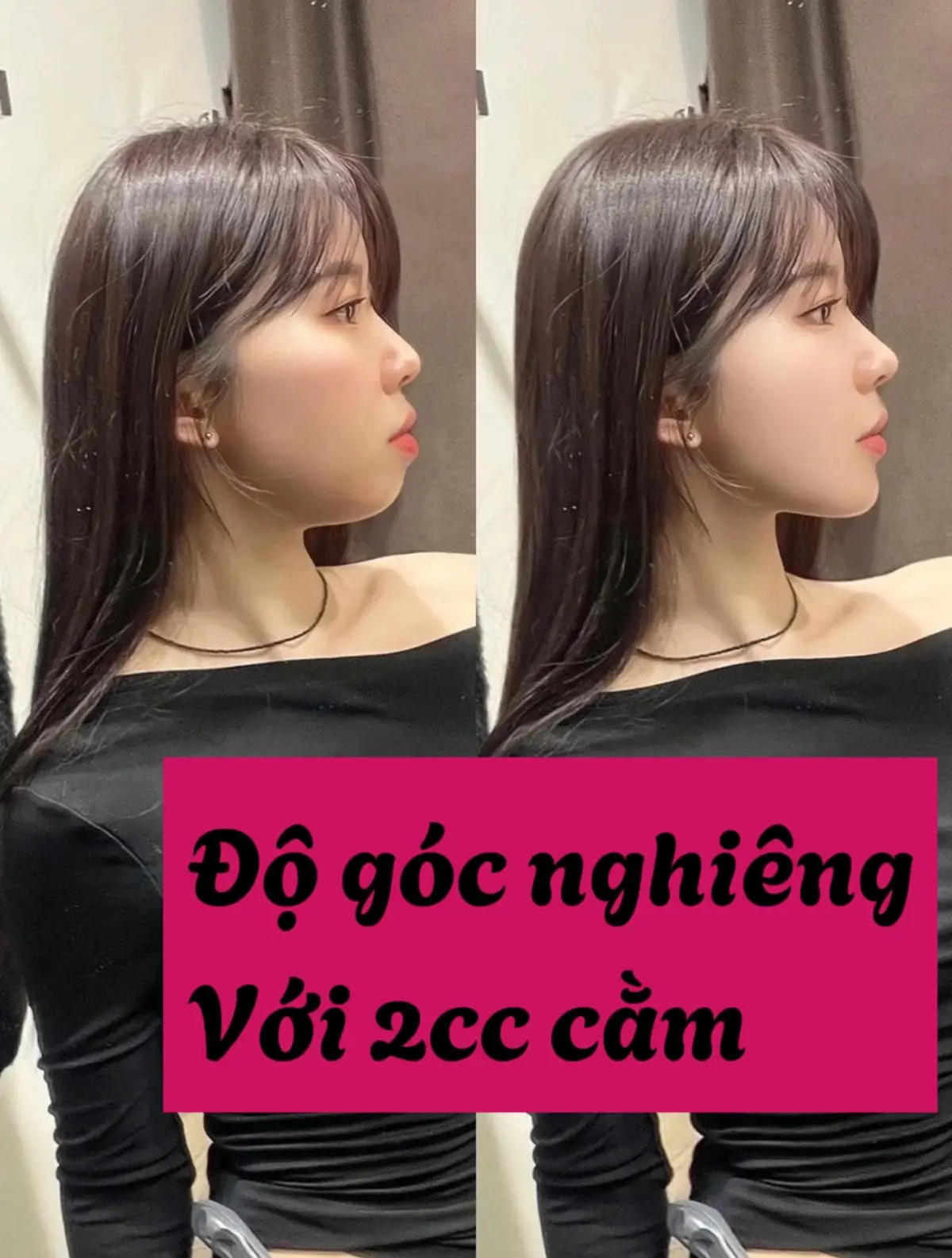 Filler cằm, bạn sẽ khác như thế nào ??? #goclamdep #LearnOnTikTok 