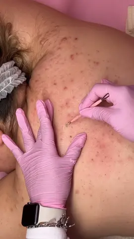 Book a back facial NOW & be ready for the summertime 👙 I offer a variety of back treatments to cater to your skin concerns 💁🏻‍♀️ #esthiebestie #dfwfacials #acnetreatment #spa #dallas #dfw 