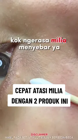 Jangan biarkan milia menyebar! CEPAT ATASI MILIA dengan 2 produk ini. Milia hempas #leikaskincare #ahabhaserum #serumkhususmilia #miliadimata #ahabhanightcream #paket2in1milia #solusimilia 