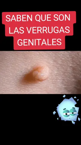 Que son las verrugas genitales#verrugas #verrugasgenitales #verrugasdelvph #verrugasvph #condilomas #condiloma #condilomaacuminado #papiloma #papilomavirus #papilomatosis #papilomavirushumano #papilomavirushumanos #hpv #HPV #condilomatosis #virusdelpapilomahumano #viruspapiloma #verrugasvirales #verrugasdelpvh #verrugasorales #verrugasdelpvh #ets #ETS #enfermedaddetransmisionsexual #enfermedadtransmisionsexual #infecciondetransmisionsexual #transmisionsexual #mujer #hombre #mujeres #hombres #hombresvsmujeres #hombresymujeres #ginecologia #ginecologo #obstetricia #ginecólogo #obstetra #mujeresqueinspiran #medicina #medicinahumana #gestante #embarazo #gestacion #salud #saludfemenina #saludfemeninanatural #saludfemeninaalalcancedetodos #higieneintima #higienefemenina #vida #viraltiktok #videotiktok #videoviralitiktok #videoviraltiktok #tiktokenseña #tiktokenseñamisvideosporfavor😩 #tiktokenseñame #aprendiendoentiktok #aprendiendocontiktok #aprendiendodetiktok #AprendeEnTikTok #AprendeConTikTok #aprendedetiktok #epi #EPI #ginecología #ginecologíaenperú #cosasdeparejas #cosasdemujeres #esposo #esposa #esposos #esposas #limaperu🇵🇪 #limaperu #lima #enunminuto #necesitabasaberlo #ginecologovirtual #ginecologoenlinea #oncologia #cancer #cuellouterino #cervix #adolescente #menopausia #climaterio #climaterioymenopausia #fertilidad #infertilidad#planificacionfamiliar #medico #medicos #medicosdetiktok #medicostiktok #medicosentiktok #tipsmedicos #tipsmedico #tipsmedicostiktok #medicaltiktok #ginecologiayobstetricia🤰🏻👩🏻‍⚕️😷 #ginecologiaeobstetricia #ginecologianatural #ginecologiaymujer #talentotiktok #talentostiktok #educacionsexual #parejas #parejassexuales #saludybienestar #hpv18 #hpv16 #mujeresyhombres #mujeresfuertes #lesionesverrucosas #picazon #prurito #cancersucks 