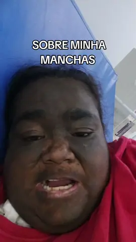 As minha manchas e marca registrada mas falaram quem depois do transplante a pele volta ao normal... #rotina #rim #hemodialiseevida #hemodialise #renalcronico #renal #jaraguadosul #tiktok #pele #saude #angola🇦🇴portugal🇵🇹brasil🇧🇷 