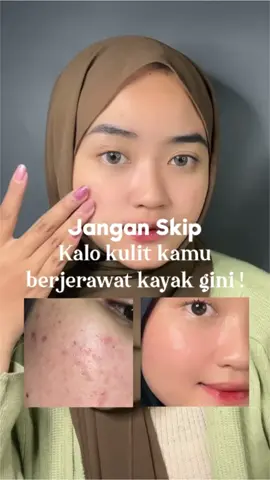 Jangan skip kalo kamu punya kulit berjerawat kayak gini, karena aku punya solusinya 🤩 #daycream #nightcream #acnemousturizer #moisturizerjerawat #hilangkanjerawat @Scarlett Whitening Official 