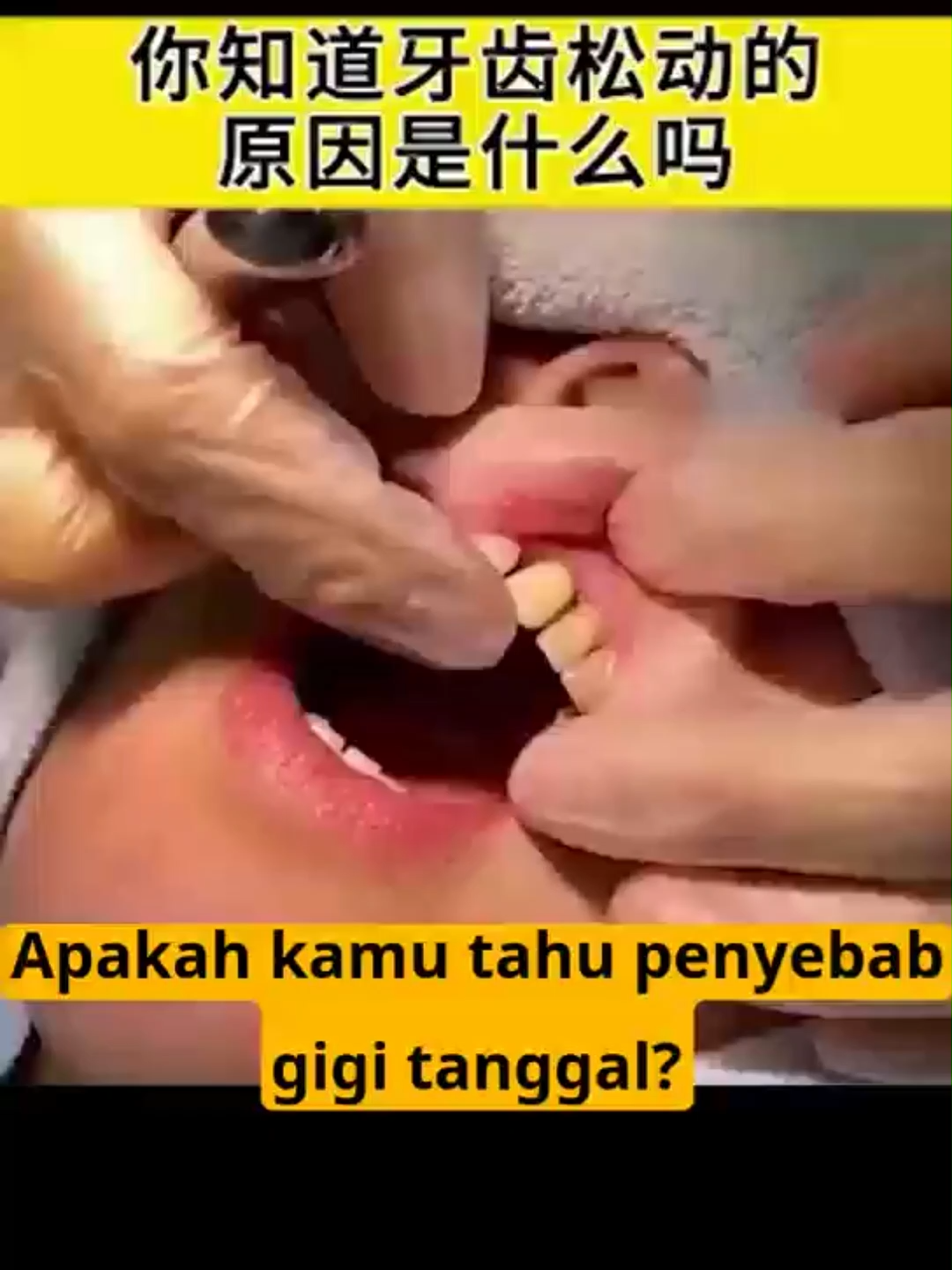 Dengan itu, gigi tidak lagi goyang