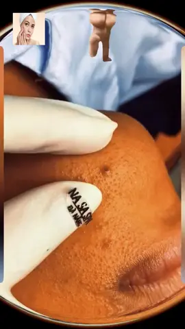 #squeeze  #squeezeyuk  #acne  #pimple  #pimplepop  #blackhead  #satisfying  #foryoupage