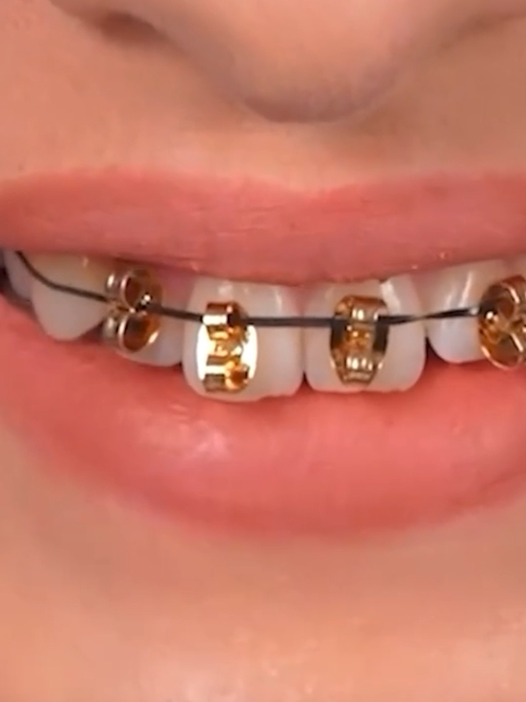 Doing This Can RUIN Your Teeth Forever! 🦷🚫 #braces #teeth #dont