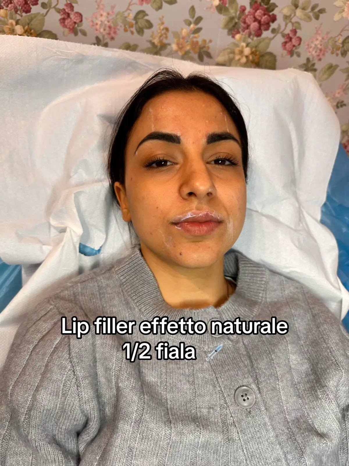 Risultato naturalissimo lip filler con 1/2 fiala #lipfiller #filleabbra 