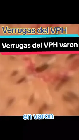 eliminacion de verrugas del VPH#lunarcarnoso #verrugasfaciales #condilomasbucales #vphhombre #condilomasdelvph #acrocordones #vphmujer #vphmujer #verrugascorporales #herpes 