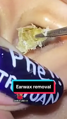 Earwax removal.. #earcleaning #earwaxremoval #limpezadeouvido #earwaxcleaning #earwax 