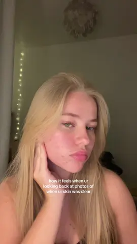 to have clear skin again 🥲