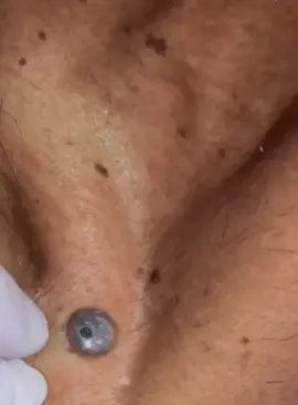 #Isegretidellapelleperfetta #cravos #Suggerimentiperlenirel #brufoli #blackhead #zit #asmr #popping #pimples_brufoli_ #zits #pimples #granos #acne #popper #pimple #granosyespinillas #pimplepop #pimples_brufoli 