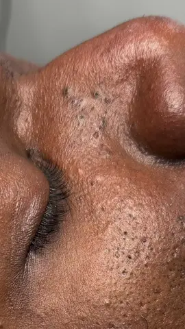 Part 4 🥳 #extraction #extractions #extractionslovers #extractionsatisfaciton 