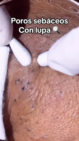 #Extracción #poros #granos#pelo #espinillas #limpiezafacial #acne #tratamientos 