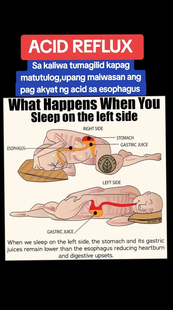 MAINAM na POSISYON ng PAGTULOG kapag MATAAS ang ACID  #acidreflux #GERD  #MAGNESIUMSALTSPRAY #NATURALNAPANLUNAS #transdermalmineralsupplement #MSS #allinone #minerals #miraclespray 