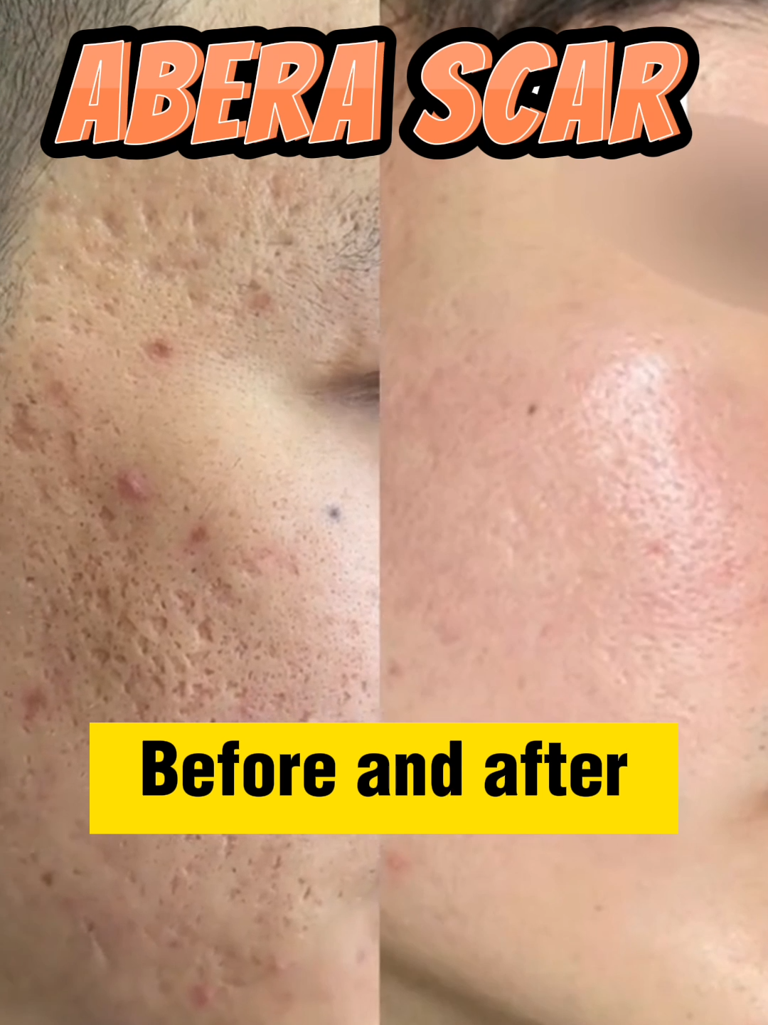 The journey to treat acne basket scars at home in just a few weeks #aberascar #scartreatment #abera