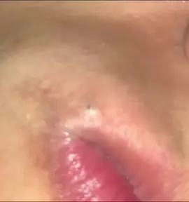 #Isegretidellapelleperfetta #cravos #Suggerimentiperlenirel #brufoli #blackhead #zit #asmr #popping #pimples_brufoli_ #zits #pimples #granos #acne #popper #pimple #granosyespinillas #pimplepop #pimples_brufoli 