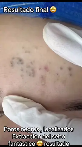 #Extracción #poros #granos#pelo #espinillas #limpiezafacial #acne #tratamientos 