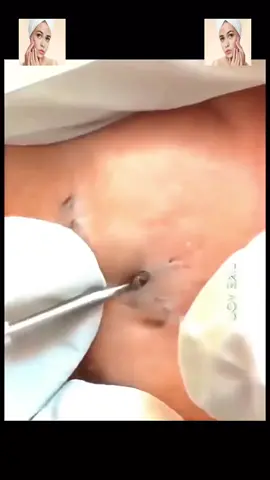 #squeeze  #squeezeyuk  #acne  #pimple  #pimplepop  #blackhead  #satisfying  #foryoupage