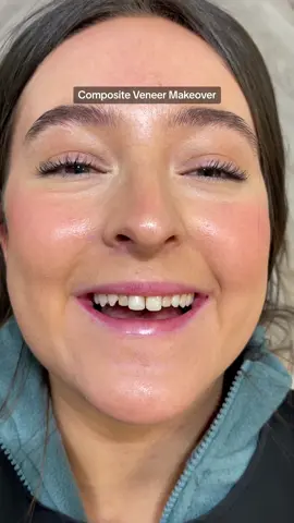 In this case I replaced existing composite work (done elsewhere on the front 4 teeth) using 8 direct composite veneers to create more even lengths/shapes of the teeth. We also changed the shade of the teeth with the direct composite veneers 🤍 The patient had baby teeth still present which is why the 2nd tooth on each side was so small ✨