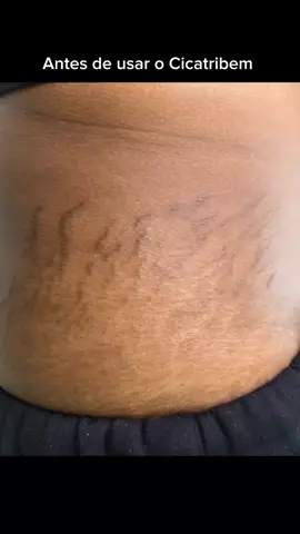 É inacreditável esse resultado com apenas 30 dias de uso, venha mudar a sua pele também usando cicatribem e trate aquelas estrias indesejadas 😍 #estriasescuras #estriasvermelhas #estriasbrancas #cremeparaestrias #estrias #autocuidado #amorpropio #mulheres #cuidese #DicaseTruquesdeConcealer #estriastemtratamento #cicatribem #resultadoem30dias #tratamentode30dias 
