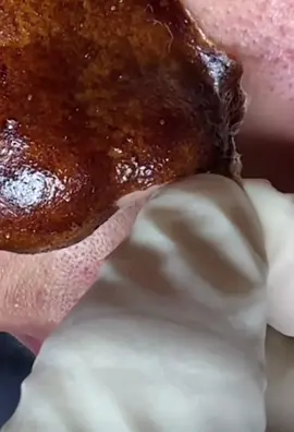 #cravos #brufoli #blackhead #zit #asmr #popping #pimples_brufoli_ #zits #pimples #granos #acne #popper #pimple #pimples_brufoli #granosyespinillas #pimplepop #Suggerimentiperlenirel 