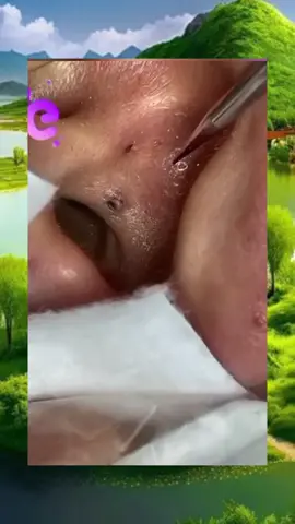 #squeeze  #squeezeyuk  #acne  #pimple  #pimplepop  #blackhead  #satisfying  #foryoupage