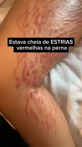 O creme que vai te ajudar com qualquer tipo de estrias, você vai amar os resultados e não vai largar jamais o tratamento que funciona 🩷 #cuidese #beleza #mulheres #estrias #estriasvermelhas 