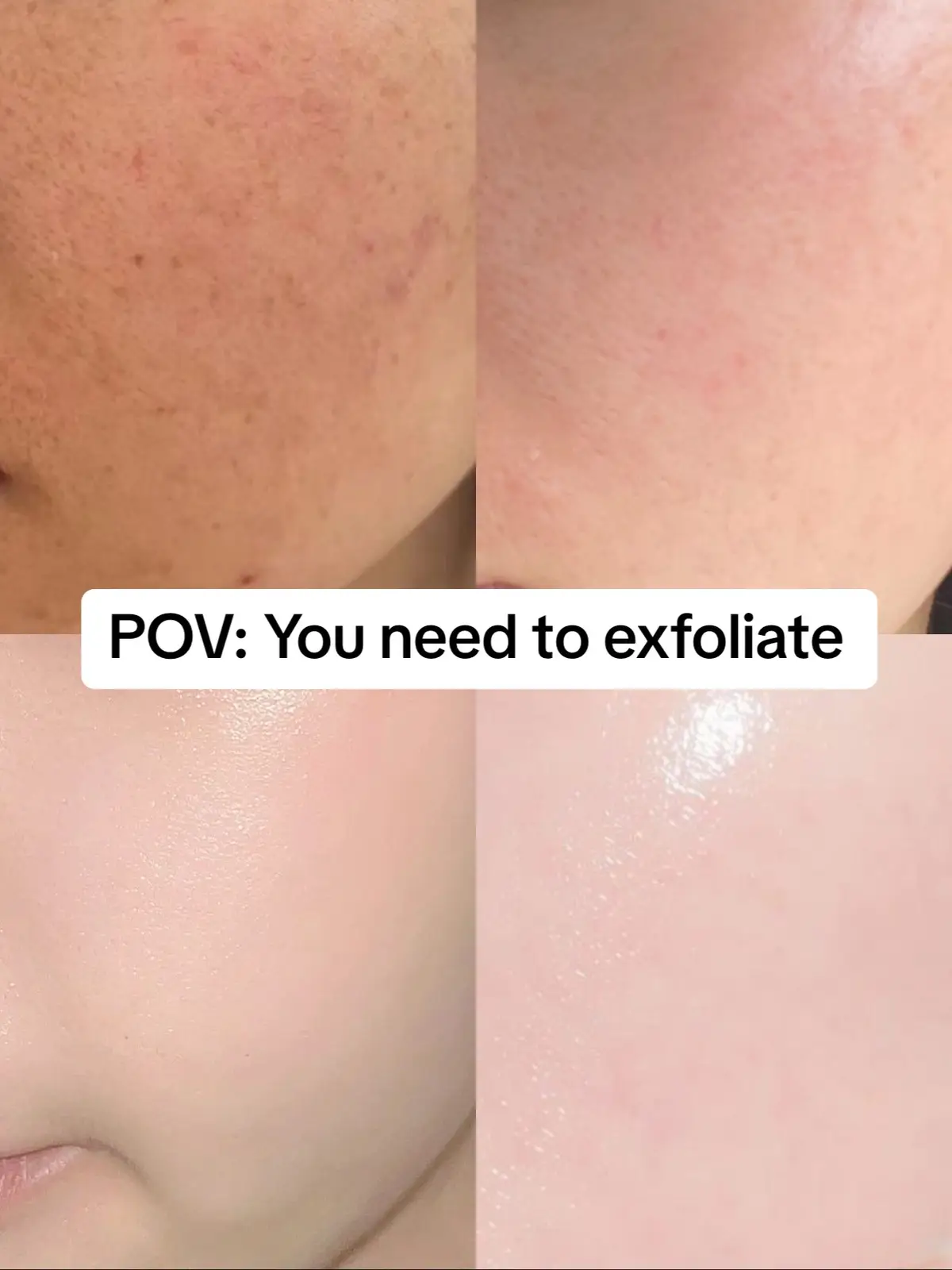 #povyouneedtoexfoliate #largepores #bleackheads #oxidizedsebum #closedcomedones #tonerpads #exfoliation #glassskin #glassskincare #glasskinroutine #cici4646 