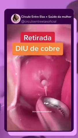 O DIU DE COBRE É Superior ao hormonal, o DIU de cobre pode ser mantido no útero por até 10 anos.  Além disso, por não envolver o uso de hormônios, a versão envolve menos efeitos colaterais  O procedimento de retirada do DIU costuma ser rapido e indolor. Me conta, você usa DIU como foi a colocacao ou retirada? #diudecobre #diu #saudedamulher #saudefeminina #fyyyyyyyyyyyyyyyy #fyp 