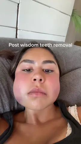 Post wisdom teeth removal #drgigidree #fyp #viral 