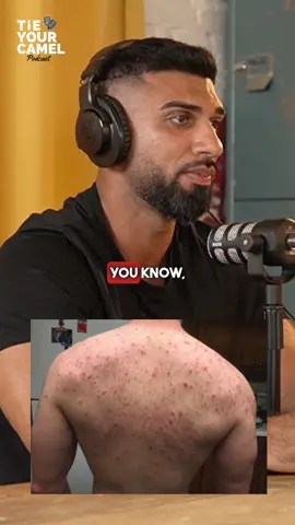 The Side Effects of taking STEROIDS! Weight loss and body transformation expert @SBG - Online Coach explains the side effects of taking steroids 🎙️ Follow for more clips on health, wealth, and productivity. #gymmotivation #gym #gymrat #GymTok 
