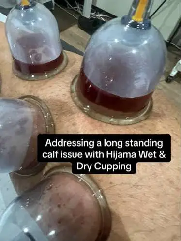 This dedicated session aimed to resolve a long-standing calf injury for our client. Combining targeted therapy and wet cupping, we achieved significant relief in just two sessions, effectively alleviating the pain that had persisted for six months. Witness the transformative impact of our tailored approach to wellness!  @HertsCupping ✅ Like | Share | Tag  . . . . . #WellnessSuccess #InjuryRecovery #hertscupping #hijamacuppingtherapy #hijama #cupping #cuppingforinjury #injuryrelief #stalbans #stalbansbusinesses #hertfordshirebusiness #painrelieftreatment #injuryrecoveryprogress #calfpain #calfpainrelief #naturalpainrelief #legpainrelief #naturalpainkiller 