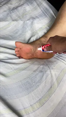 Put toothpaste on your feet and the next day you won't believe the results! #fy #fyp #fypシ #foryou #foryoupage 