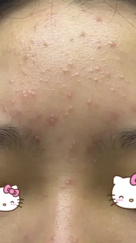 사람 한명 살리는셈 치고 읽어주세요ㅜㅜ 제가 원래 이마에 여드름이 이정도보다 심했는데 한 몇달동안 세수도 자주하고 스킨케어도 잘해서 거의 없어졌었는데 방학하고 나서 몇일뒤부터 피부가 엄청 뒤집어졌어요 곧 졸업식이고 졸업하고 몇일뒤에 고등학교 입학인데 저 어떡해요 ㅜㅜ  피부과는 부모님이 반대해서 못간답니다 일단 제 스킨케어 루틴을 알려드릴테니까 고칠점좀 얘기해주세요 일단 아침 저녁으로 2번씩 세안하고 나갈일있으면 365일이라는 브랜드 썬크림을 발라요 유통기한이 21년까지긴한데 유통기한지난지 모르고 23년 일년동안 잘 썼는데 얼마전에 보니까 유통기한이 저래서 깜짝놀라고 지금은 안쓰고있어요 일단 세수할때 미온수로 하고 손 꼭 씻고폼클렌징은 메디필 초록색 이용하고있어요 그리고 세수하고 수건은 톡톡 닦고 먼저 메디필 초록 패드 사용하는데 다 써서 시킨다고 몇일 사용안했고 다음 손으로 독도토너 얼굴에 바르고 다음 메디필 시카안티오크림 바르고 마무리 해요 근데도 일년동안 여드름폭탄이에요 얼마전에 샴푸를 케라시스 엘레강스 퍼퓸샴푸로 바꾸긴 했는데 그것때문인가 싶기도하고 잘 모르겠어요 하 제발 저좀 살려주세요 아무 도움이라도 주세요 여드름때문에 방학동안 배달음식이나 기름진음식 안먹고 식단조절 할려구요 ㅜㅜ 아 그리고 저 화장은안해서 화장품 관련은 아닙니다 연고라던지 스킨케어제품 혹은 팁같은거 부탁드려요 제발 광고는 사절이고 효과보신분들이라던지 댓글 부탁드려요 긴글읽어주셔서 감사합니다🥺💗