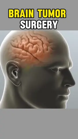 Brain tumorsurgery (Keyhole Brain Tumor & Skull Base Surgery) #Brain #braincancer #braintumor #brainteaser #tumer #brainsurgery #foryourpage #keyhole #braintumor #skullsurgery 