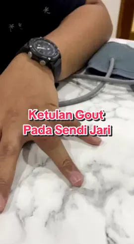 Ketulan gout yang tumbuh di sendi , tapi perlu diingatkan tak semua ketulan gout boleh dibuang . Ada juga yang perlu rujuk pada hospital .. Jom kita dengar penerangan dari Dr Walid . #drwalid #poliklinikwalid #surgerypenang #minorsurgerypenang #surgerykl #gout #ketulangout 