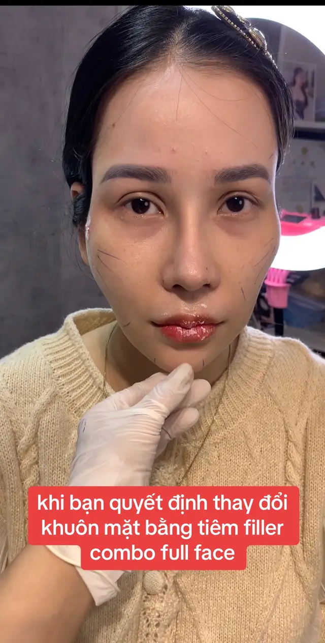 sự lựa chọn đúng đắn khi gặp em hoa ❤️#tiemfiller #fullface 