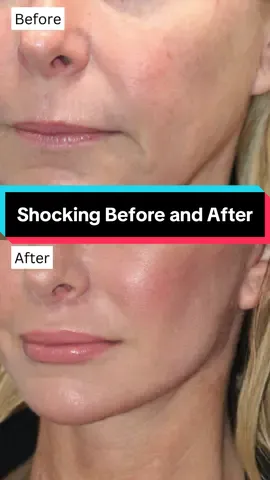 At two weeks and 51 years old, she looks incredibly natural, just like her younger self.⁠ ⁠who wouldn’t kill for that jawline at any age 🔥🔥🔥 To achieve these incredible results, we performed: ⁠ ✅Vertical Restore⁠ ✅Custom Fat Transfer⁠ ✅Lower Blepharoplasty⁠ ✅Lip Lift⁠ ✅@KaramMD  Trifecta for 6 months to address skin concerns prior to surgery⁠ #facialaging #verticalrestore #faceliftnatural #beforeandafter #fattransfer #dramirkaram #skincare #transformation #fyp 