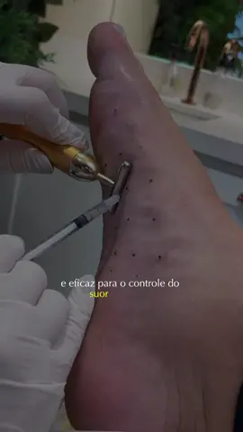 Hiperidrose: tratamento com aplicação da toxina botulínica 