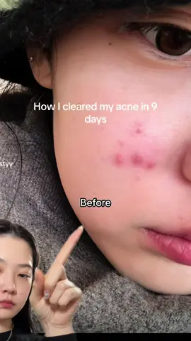 These acnes are not your normal acnes they’re very hard to get rid of😭I’ve been using the medicube pure vita C for more than a week and ive seen so much improvement!😍 #medicube #medicubeambassador #acneskin #hormonalacne #acnescar #skinbarrier #skincare #skincaretips #skincareroutine #kbeauty #boosterh #vitaminc #koreanskincare #glowyskin 