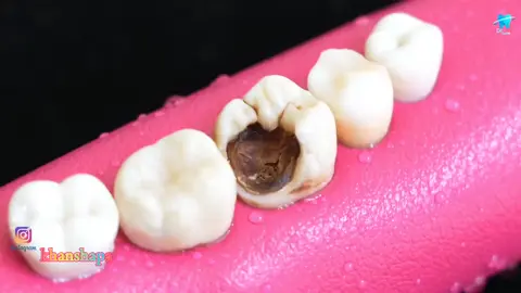 CLASSIC RESTORATION OF  DECAY TOOTH BY ROOT CANAL AND GOLD CROWN #drsafiu #foryoupageofficiall #viralvideotiktok #forupage #unfreeze #myaccount #tiktok #groveaccount #lovedentistry #for #you #tiktokpakistan 
