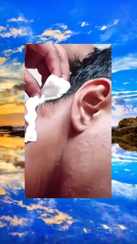 satisfying extraction explore acne squeeze  popping pimple asmr suppress  (493)
