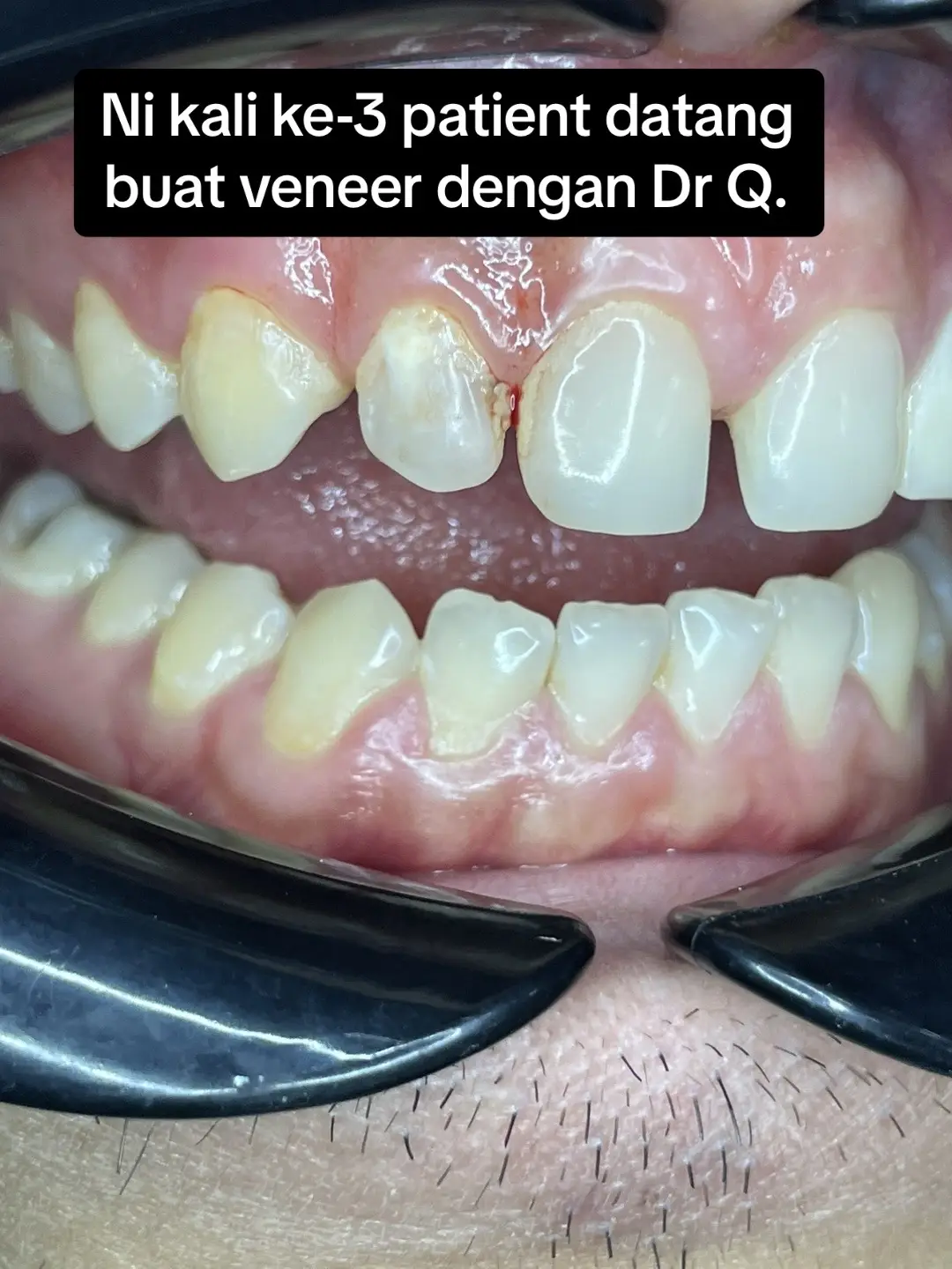 #doktorgigi #doktorgigimalaysia #doktorgigijohor #doktorgigipasirgudang #dentistpasirgudang #dentist #klinikgigi #klinikgigipasirgudang #dentalclinic #dentalclinicpasirgudang #veneerpasirgudang #compositeveneerpasirgudang 