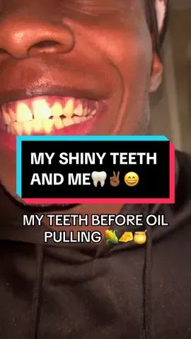 MY SHINY TEETH AND ME 🦷😩 #oilpulling #gurunandaoilpulling #oilpullingbenefits #oilpullingforteeth #gurunanda #whitesmile #foryou #viral