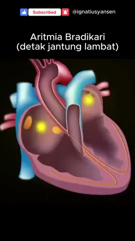 Kelainan listrik jantung dapat menyebabkan kelainan irama jantung. Kelainan listrik jantung berasal dari 3 bagian jantung: - Sinoatrial Node (pacu jantung alami) atau AV node (jalur listrik jantung) - Serambi/atrium/bagian atas jantung - Bilik/ventrikel/bagian bawah jantung  #penyakitjantung #aritmia 