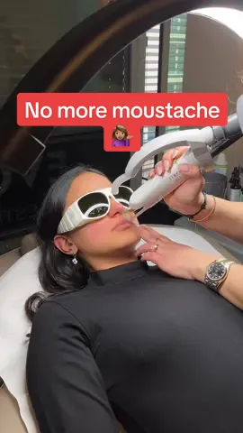 A quick fix😉 takes a minute to do but lasts so so long🥹 #laserhairremoval #moustache #desi #hairremoval #fy 